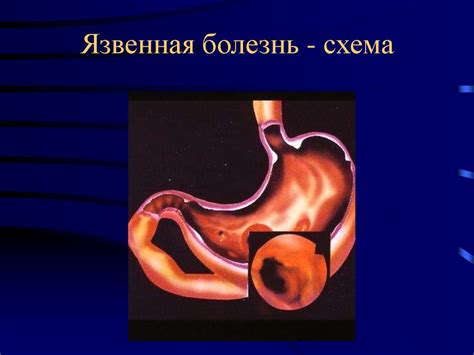 Патология пищевода и желудка. Хронический гастрит. Язвенная болезнь ...