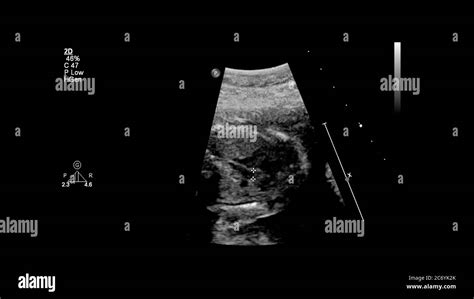 Fetal Echocardiography Examination High Resolution Stock Photography