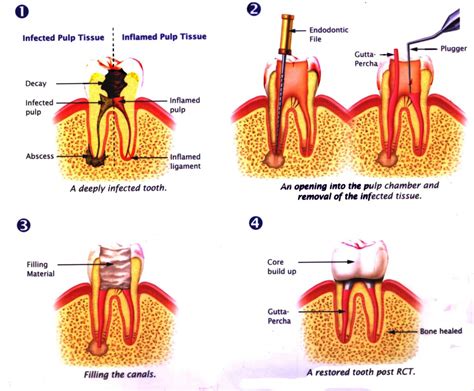 Root Canal Treatment Prestige Dental My