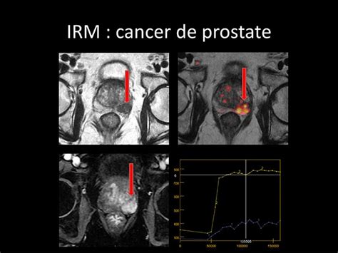 Les 40 Meilleures Image Suspecte Irm Prostate 115994 Fonddecranrwk