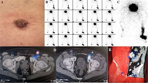 Frontiers SPECT CT Guided Surgical Removal Of A Positive External