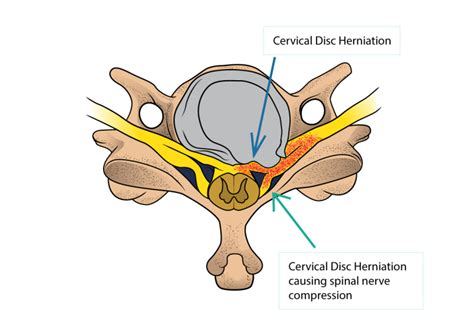 Cervical Disc Herniation And Cervical Radiculopathy Dr Yu Chao Lee