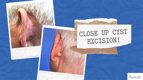 Benign Ear Cyst Or Tumor As Related To Rid Pictures