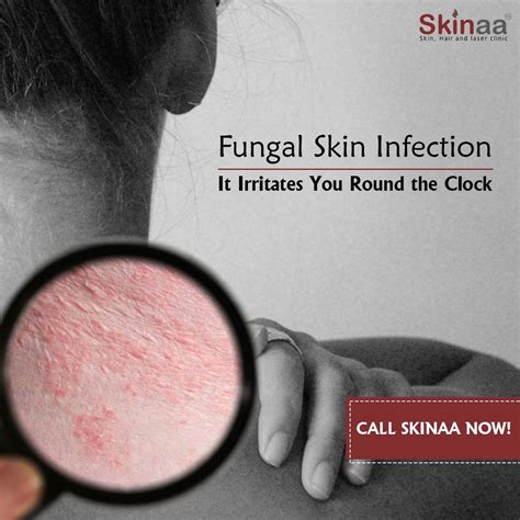 Fungal Skin Infection Skin Specialist Fungal Infection Skin Skin Infection