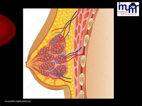 Lesiones Benignas Y Malignas De La Mama Por Ultrasonido DR ROMEL