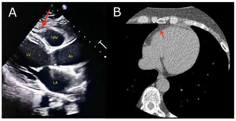 Ijms Free Full Text The Role Of Epicardial Adipose Tissue In Acute