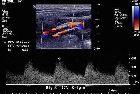 Carotid Artery Stenosis Chart Ultrasound