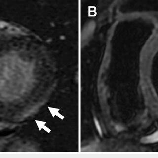 Cardiac Magnetic Resonance Imaging On Admission A Sub Epicardial