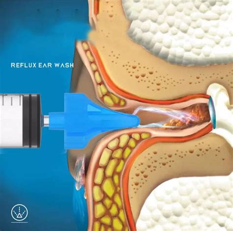 Biom Irygator Strzykawka Urz Dzenie Do Czyszczenia Uszu Medycyna Naturalna