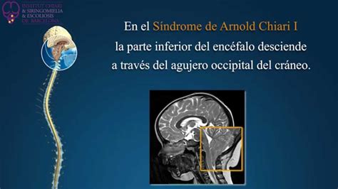 Síndrome De Arnold Chiari Siringomielia Y Escoliosis Idiopáticas