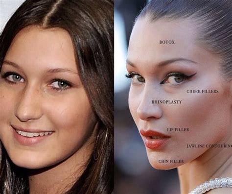 Bell LIE 3 Cosmetic Procedures Bella Hadid May Have Had LIPSTIQ