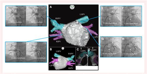 Figure 2 From Occlusion And Catheter Ablation Using A Large Size Cryoballoon For Various