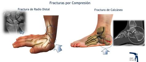 Fracturas En Traumatologia Deportiva Tratamiento Con Cirugía Y