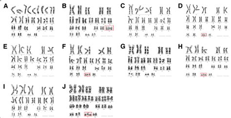 Karyotyping Results Of 3 Cases A And B Case 1 Normalt18 C And D