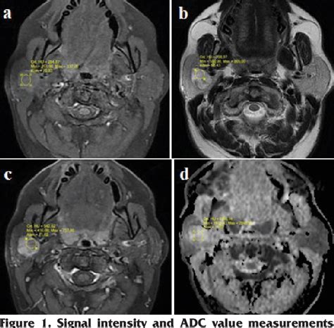 Figure 1 From Differentiation Of Benign And Malignant Parotid Gland