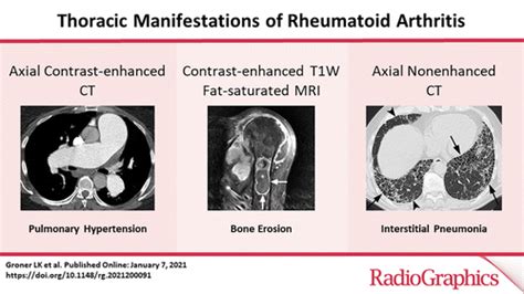 Rheumatoid Arthritis Interstitial Lung Disease - Pregnant Center ...