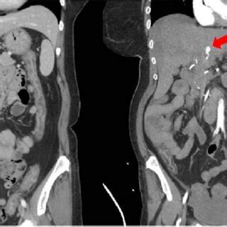 Imaging Showing Initial CT Scan Left And Repeat CT Angiogram Right