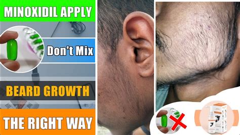 Beard Growth Apply Beard Growth Minoxidil Dont Mix Evion 400