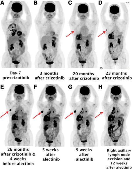 Next Generation Sequencing Reveals A Novel Nsclc Alk F1174v Mutation