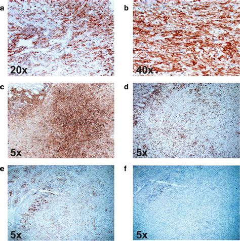 Immunohistochemical Ihc Analysis Of Pd L1 Cd4 Cd8 And Cd20 In