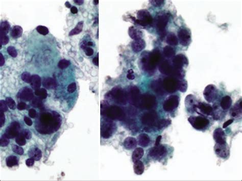 Atypical Glandular Cells Agc Cytology Of Glandular Lesions Of The