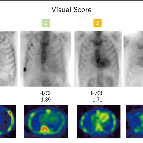 Representative Technetium M Pyrophosphate Scintigraphy Of Visual