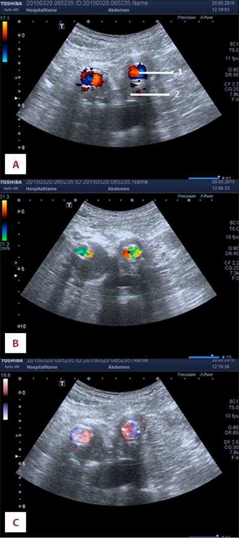 Figure 1 From Comparison Of Superb Micro Vascular Ultrasound Imaging