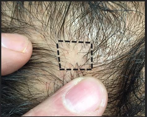 Focal Atrichia A Worrisome Sign Of Aga — Donovan Hair Clinic