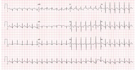 How To Read A Paediatric Ecg Medical Exam Prep