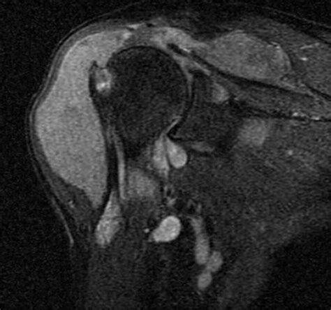 Pigmented Villonodular Synovitis Of Shoulder Sumer S Radiology Blog