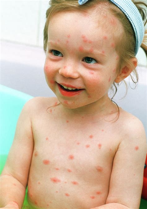 Girl With Chickenpox Photograph By Eamonn Mcnultyscience Photo Library