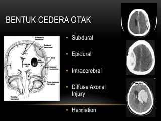 Cedera Kepala PPT