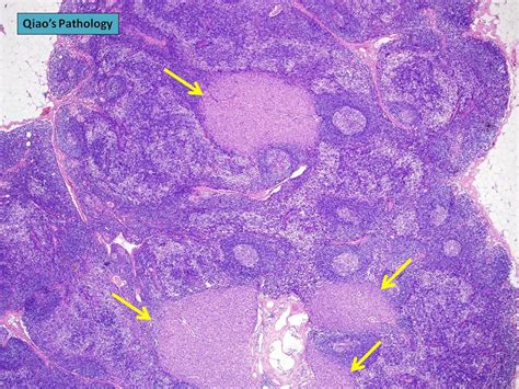 Qiaos Pathology Positive Axillary Lymph Node With Metastatic Lobular Carcinoma 乔氏病理学