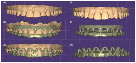 Dentistry Journal Free Full Text Three Dimensional Printed