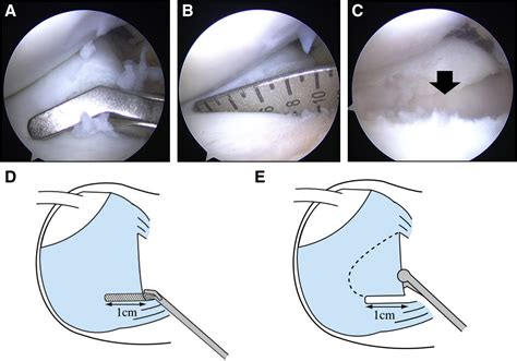 Arthroscopic Saucerization With Inside Out Repair And Anterocentral