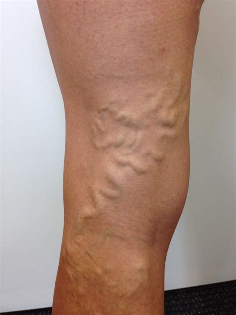 Results — The Leg Vein Doctor Brisbane Varicose & Spider Vein ...