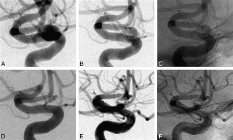 [pdf] One Year Angiographic Follow Up After Web Sl Endovascular