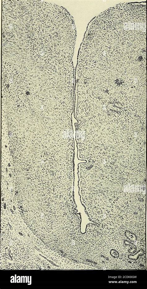 Gynecology Fig 143 —papillary Cystadenoma Of The Ovary High Power To Show An Early Stage