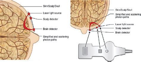 Figure From Role Of Cerebral Oximetry In Extracorporeal Membrane