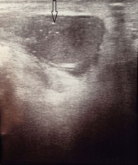 Ultrasound Of The Testicles Showed Very Small Atrophic Left Testis