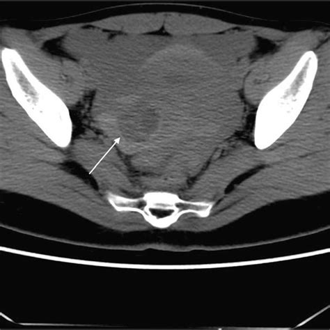 Pdf Diagnostic Utility Of Ct In Differentiating Between Ruptured