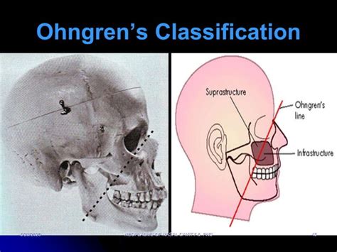 Neoplasms Of Nose And Paranasal Sinuses