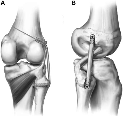 Lesión Del Ligamento Lateral Externo De La Rodilla Fisioterapia Bemov