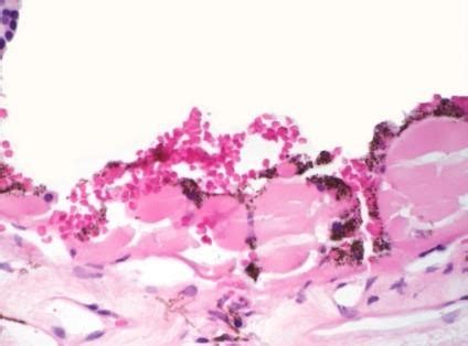 Moran Core Retina Rpe Histopathology