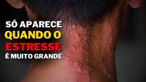 Cobreiro Como Identificar os Sintomas e Evitar o Herpes Zóster SAÚDE