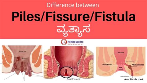 Difference Between Piles, Fissure And Fistula In Kannada, 41% OFF