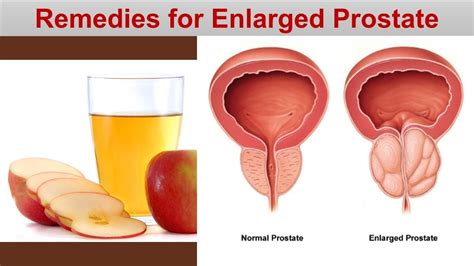 Natural Home Remedies For Enlarged Prostatecorn Silk Apple Cider Vinegar Youtube