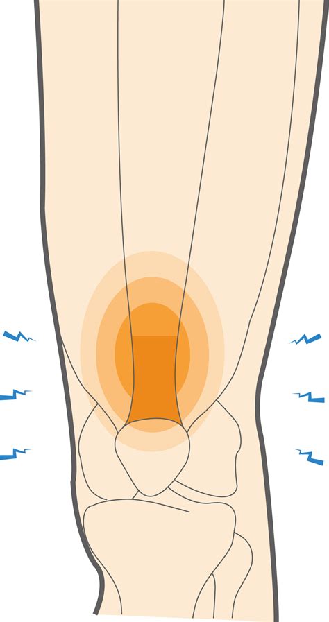 What Is Quadriceps Tendonitis And How To Alleviate Knee Pain Upswing Health