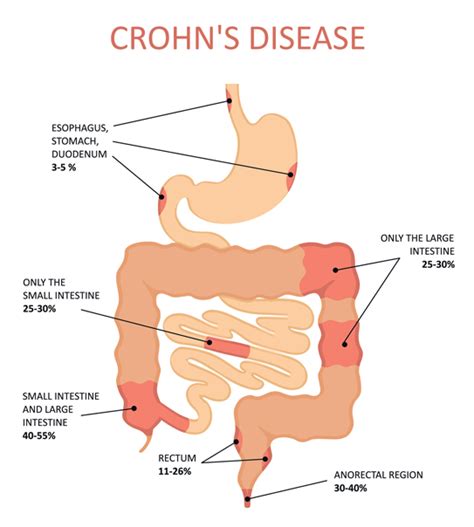 Crohns Disease Treatments Nyc By Dr Dana Cohen Md