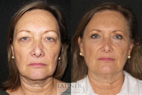 Lower Blepharoplasty Scars